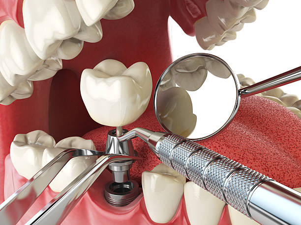 Best Emergency Gum Treatment in Vero Lake Estates, FL